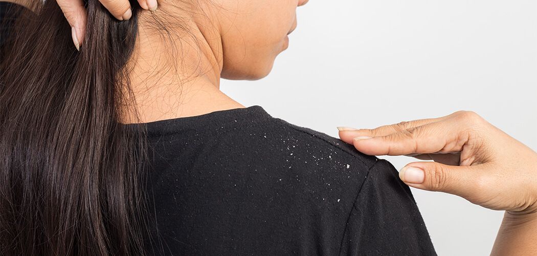 Type of Dandruff - How to Stop Hair Fall & Dandruff Naturally - Parachute Advansed Type of Dandruff - How to Stop Hair Fall & Dandruff Naturally - Parachute Advansed