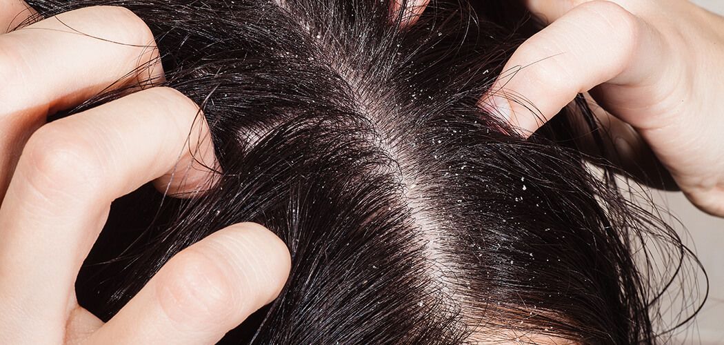 Causes of Dandruff: Reasons & Symptom for Dandruff in Hair - Parachute  Advansed