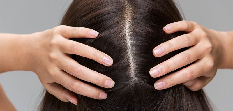 Dandruff Best Treatment