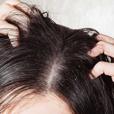 Sticky Dandruff on Scalp