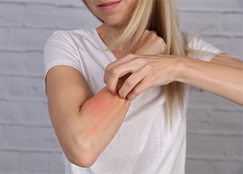 Relieve Skin Irritation and Eczema