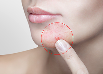 Help To Treat Acne