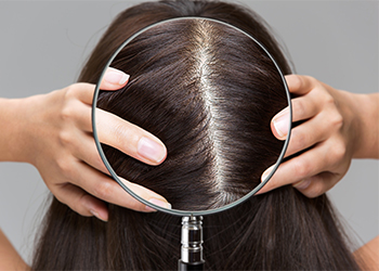 Coconut Oil for Hair Loss