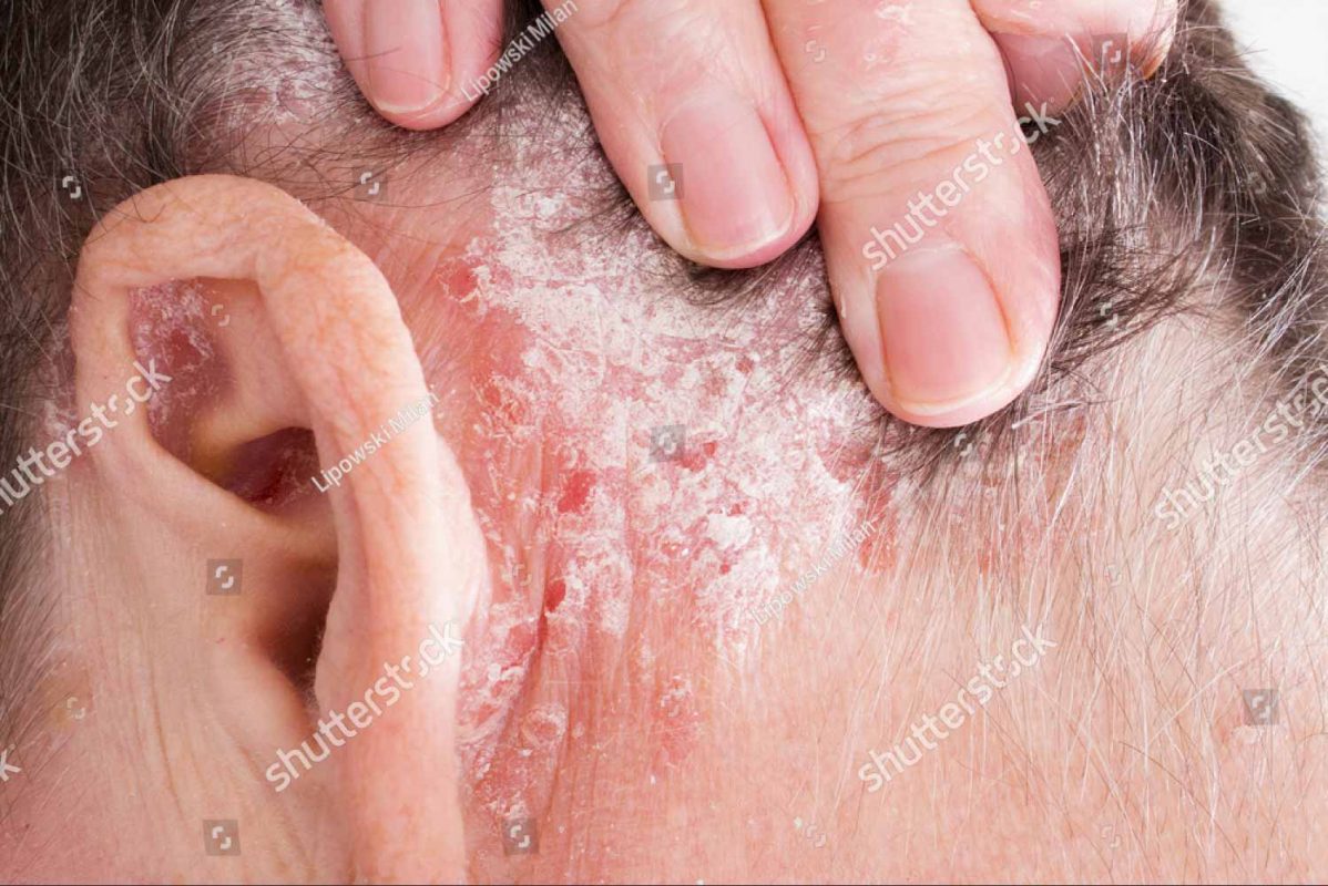 psoriatic